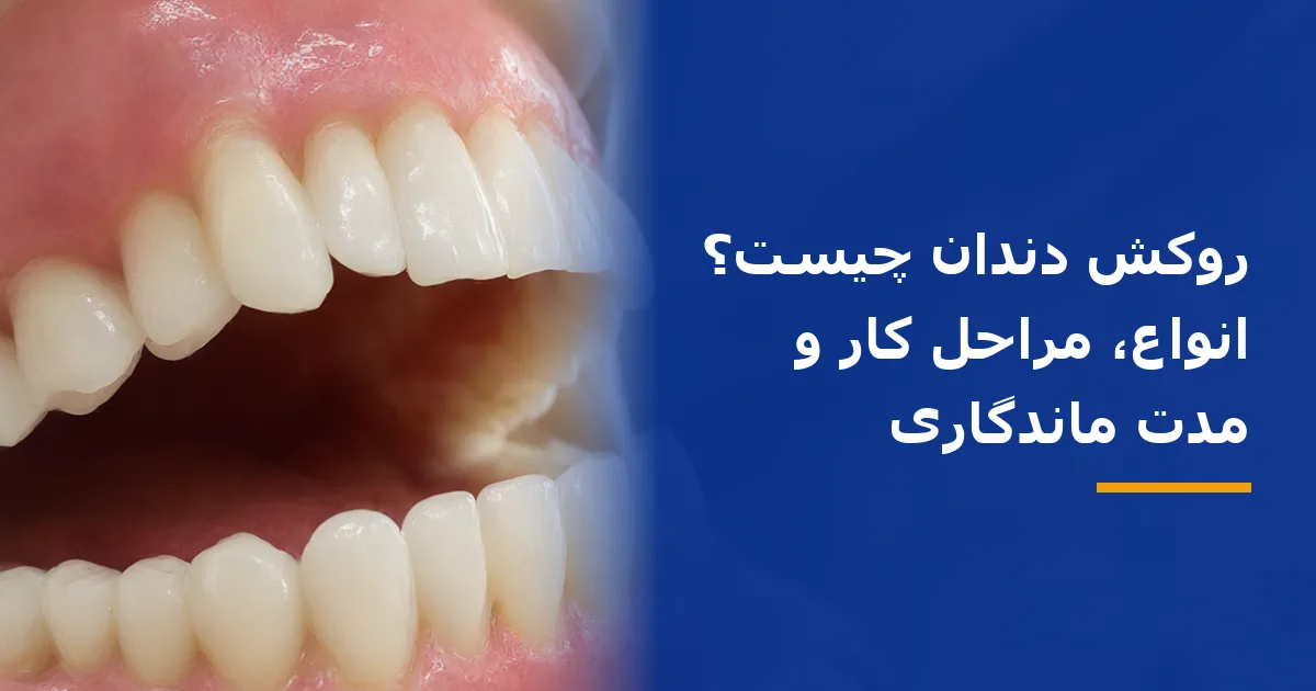 روکش دندان چیست؟ انواع، مراحل کار و مدت ماندگاری