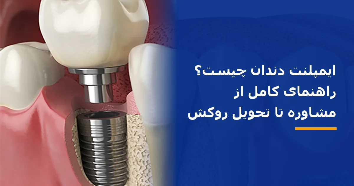 ایمپلنت دندان چیست؟ راهنمای کامل از مشاوره تا تحویل روکش