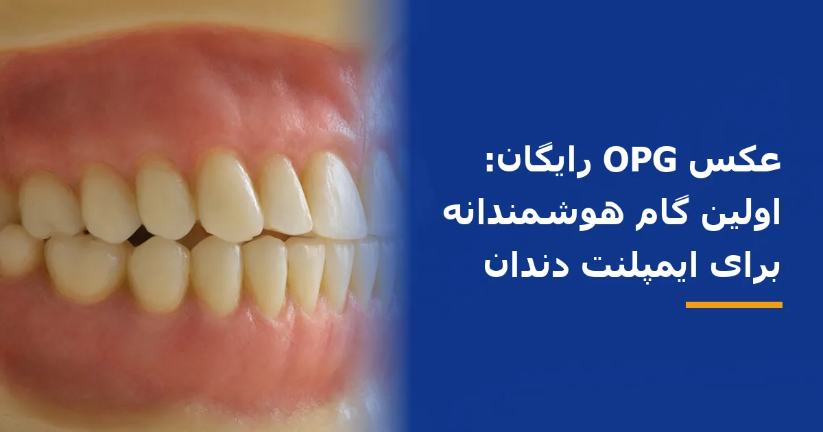 عکس OPG رایگان: اولین گام هوشمندانه برای ایمپلنت دندان